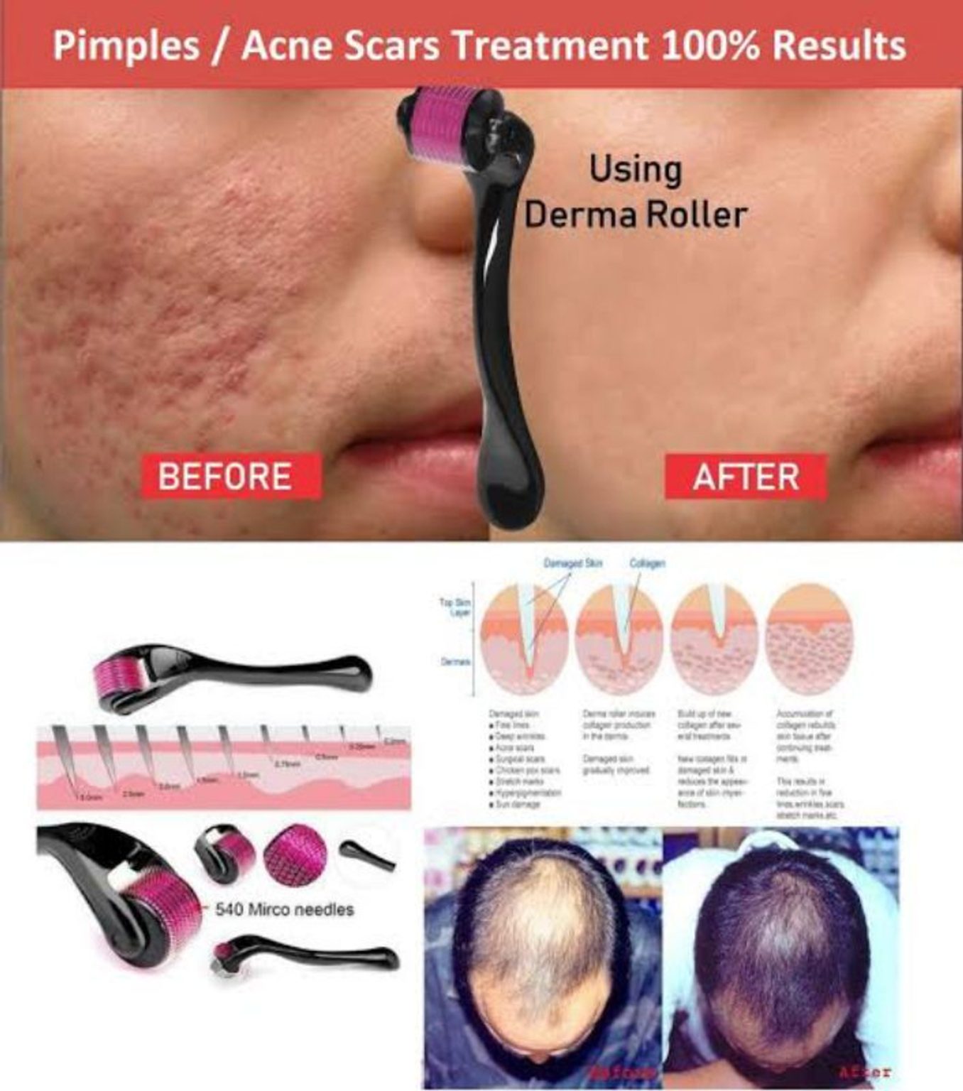 Derma Roller Set 05 Mm Roller With Free 15 Mm Rol 1704948604340 Sku 0003 0